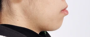 주걱턱 교정 사례