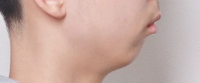 무턱 교정 사례
