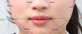 안면비대칭 교정 사례