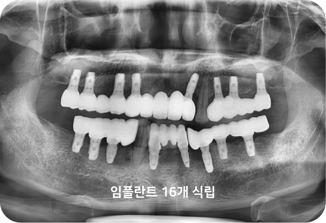 02. 엑스레이 수술 후